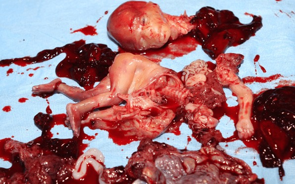 Graphic Abortion Picture
